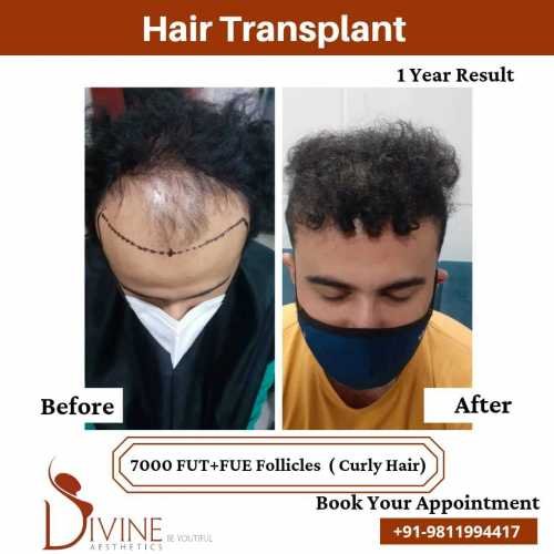 7000-follicles-Curly-Hair-Transplant-Before-After