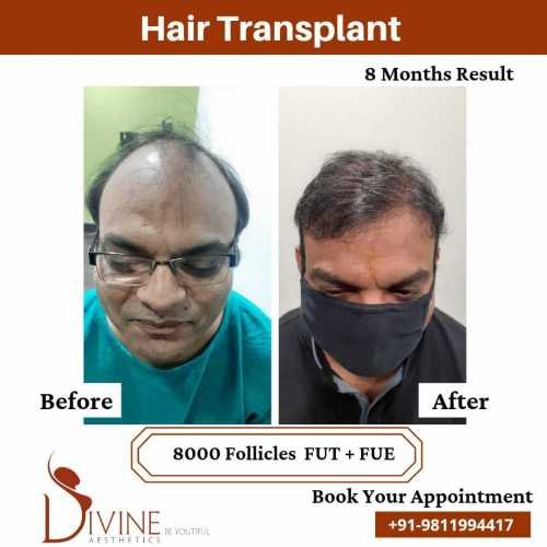 8000-follicles-Hair-Transplant-Before-After