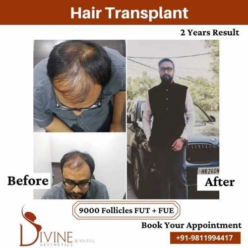 9000-follicles-Hair-Transplant-Before-After