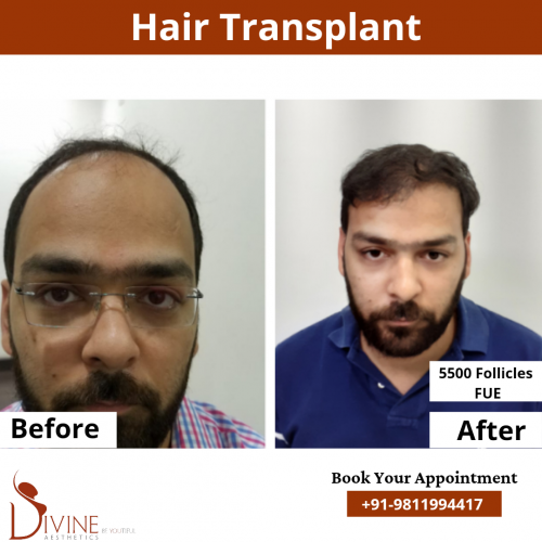 FUE-Hair-Transplant-6