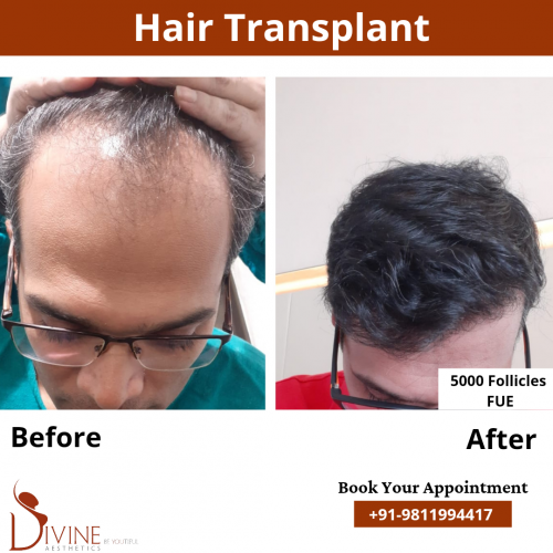 FUE-Hair-Transplant-7
