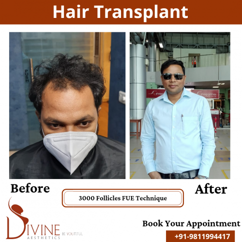 FUE-Hair-Transplant-8