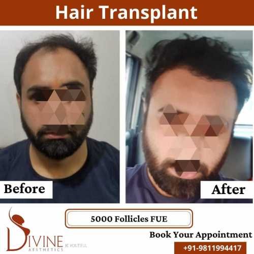 FUE-Hair-Transplant-9