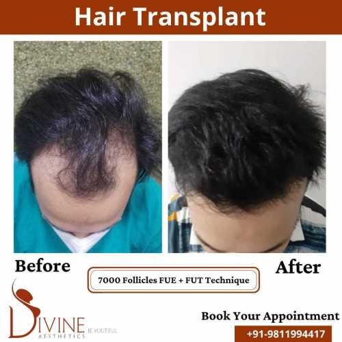 FUT-FUE-Hair-Transplant-26