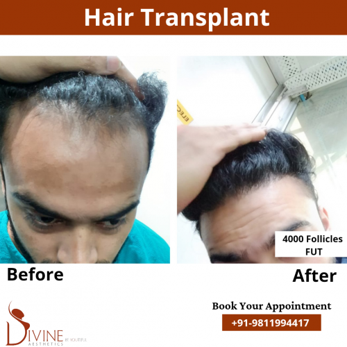 FUT-Hair-Transplant-14