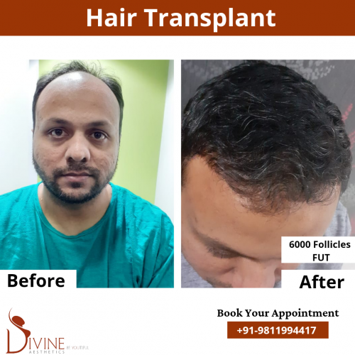 FUT-Hair-Transplant-15