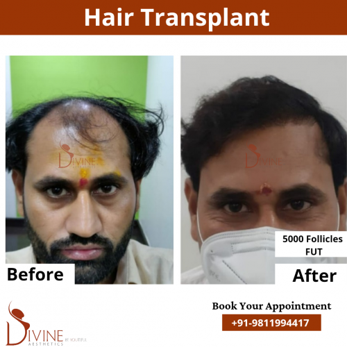 FUT-Hair-Transplant-16