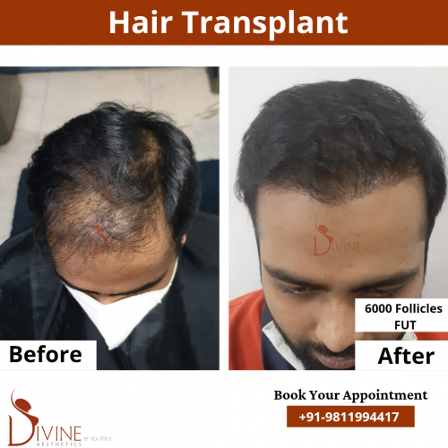 FUT-Hair-Transplant-17