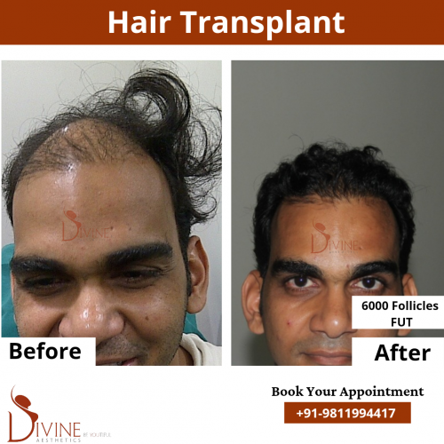 FUT-Hair-Transplant-18