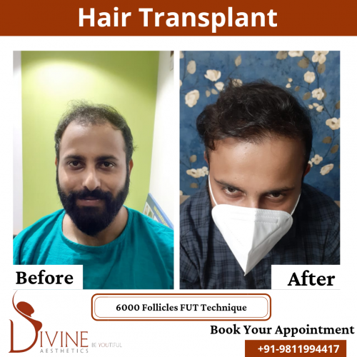FUT-Hair-Transplant-19