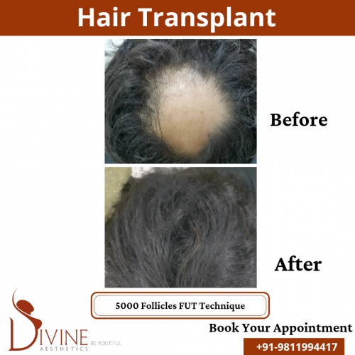 FUT-Hair-Transplant-20