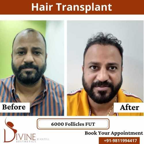 FUT-Hair-Transplant-21