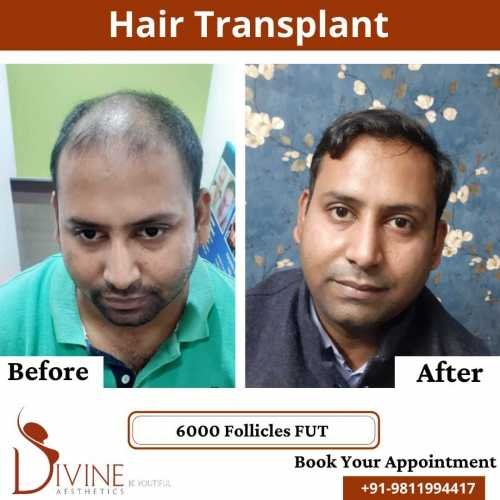 FUT-Hair-Transplant-22
