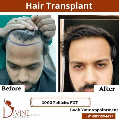 FUT-Hair-Transplant-24