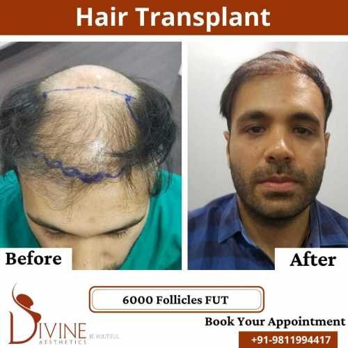 FUT-Hair-Transplant-25