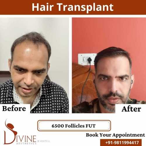 FUT-Hair-Transplant-26