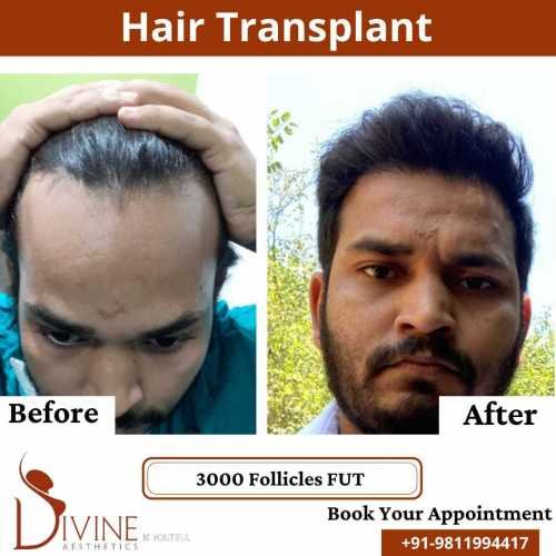 FUT-Hair-Transplant-27