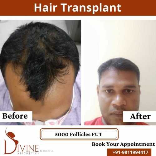 FUT-Hair-Transplant-28