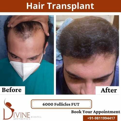 FUT-Hair-Transplant-29