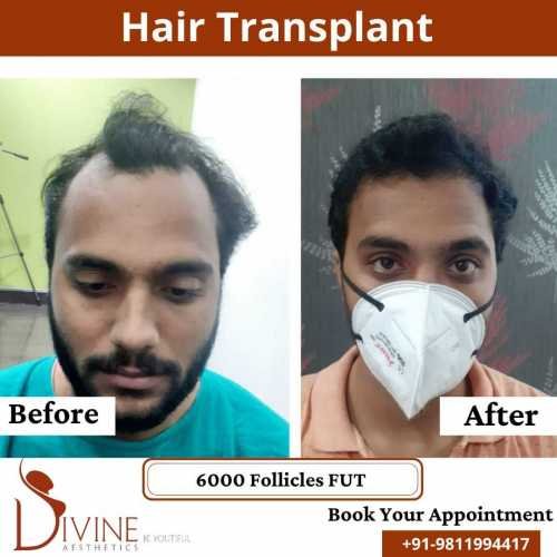 FUT-Hair-Transplant-30