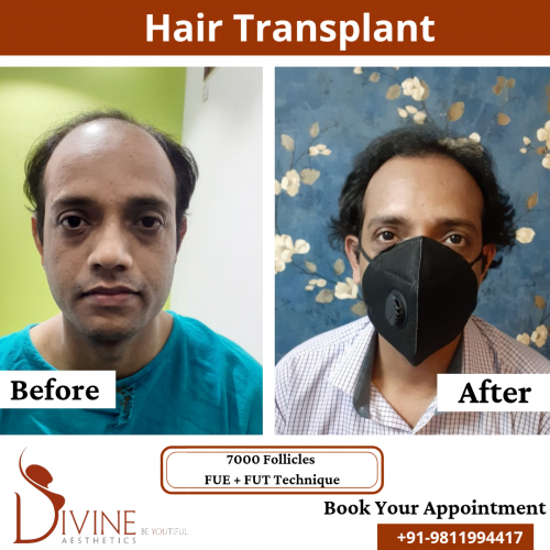 FUTFUE-Hair-Transplant-13