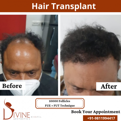 FUTFUE-Hair-Transplant-14