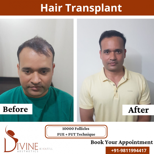 FUTFUE-Hair-Transplant-15