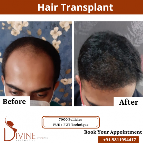 FUTFUE-Hair-Transplant-16