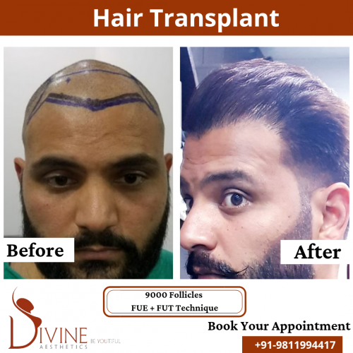 FUTFUE-Hair-Transplant-17
