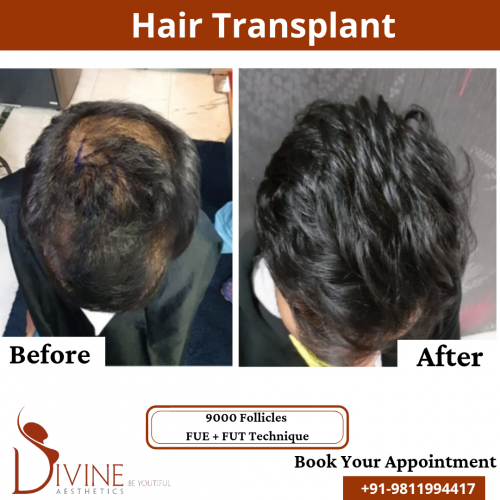 FUTFUE-Hair-Transplant-18