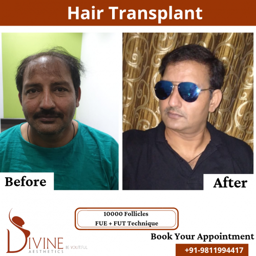 FUTFUE-Hair-Transplant-19