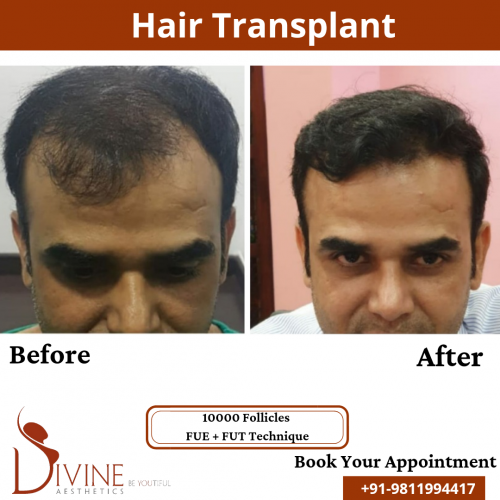 FUTFUE-Hair-Transplant-20