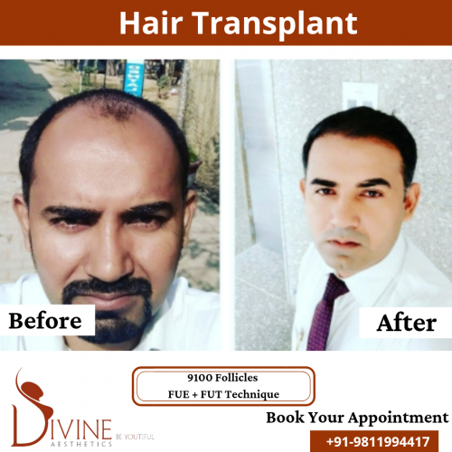 FUTFUE-Hair-Transplant-21
