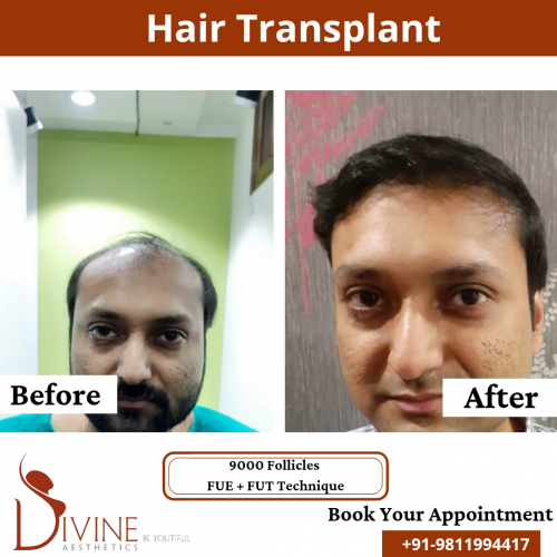 FUTFUE-Hair-Transplant-22