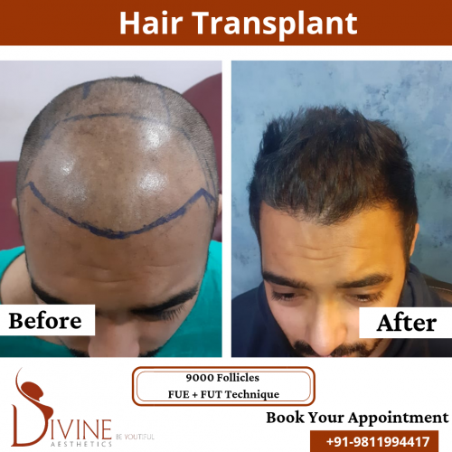 FUTFUE-Hair-Transplant-23