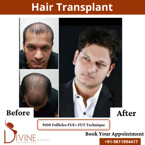 FUTFUE-Hair-Transplant-24