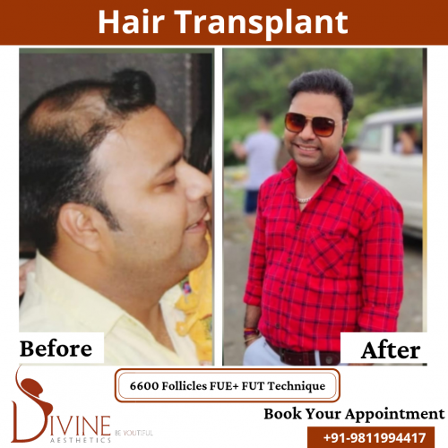 FUTFUE-Hair-Transplant-25