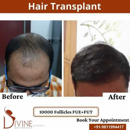 FUTFUE-Hair-Transplant-27