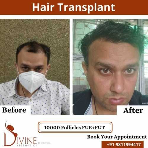 FUTFUE-Hair-Transplant-28