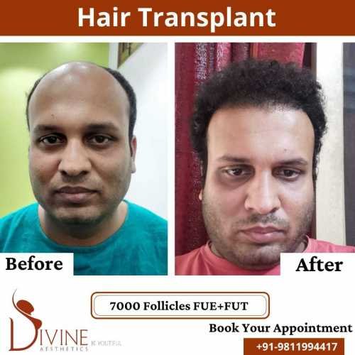 FUTFUE-Hair-Transplant-29
