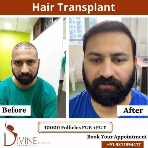 FUTFUE-Hair-Transplant-30