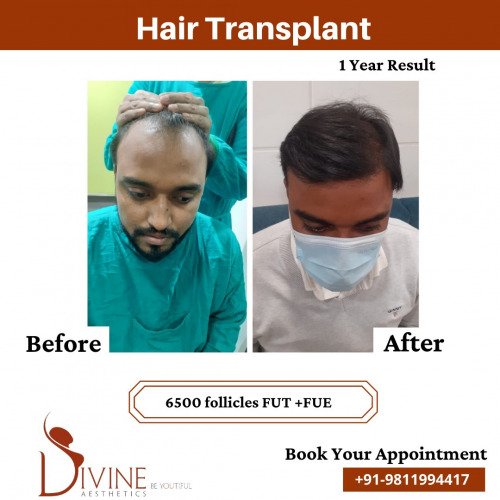 Hair-Transplant-Before-After-1-Feb-22