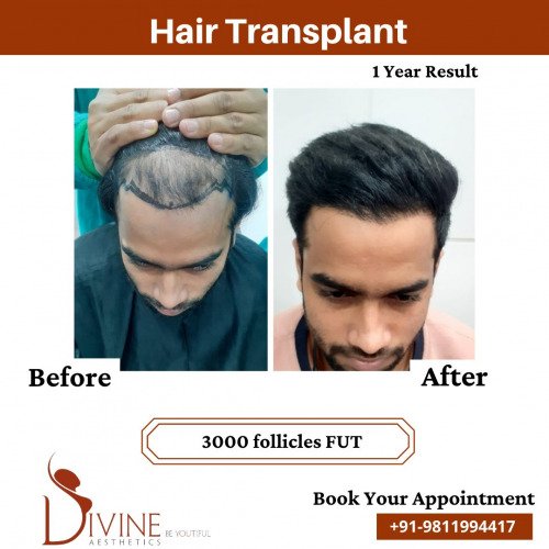 Hair-Transplant-Before-After-2-Feb-22