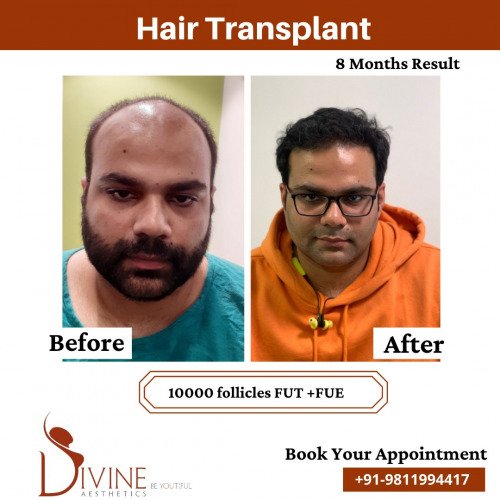 Hair-Transplant-Before-After-3-Feb-22