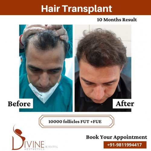 Hair-Transplant-Before-After-4-Feb-22