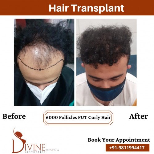 Hair-Transplant-Before-After-5-Feb-22