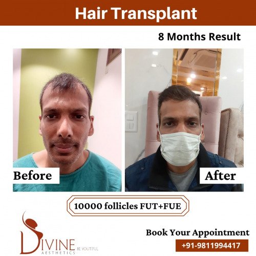 Hair-Transplant-Before-After-6-Feb-22