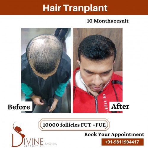 Hair-Transplant-Before-After-7-Feb-22