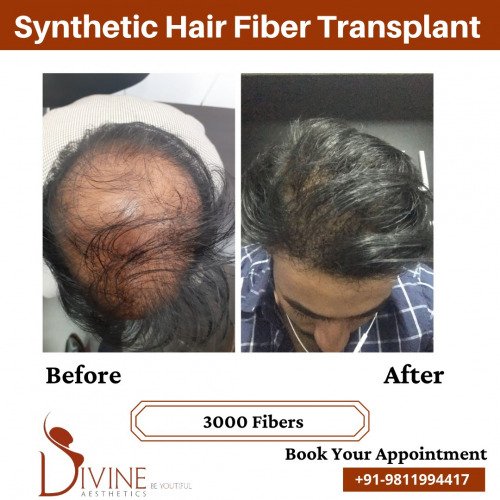 Hair-Transplant-Before-After-8-Feb-22