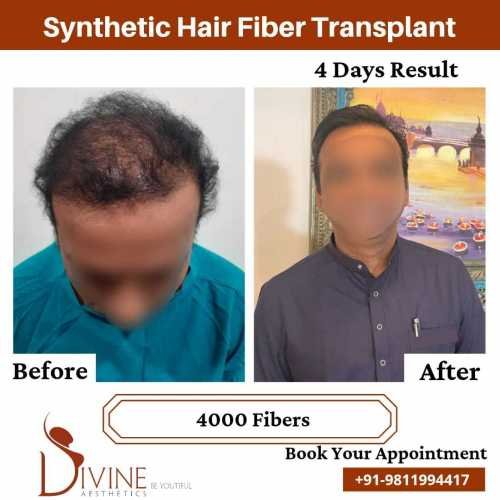 Hair-Transplant-Jan-1
